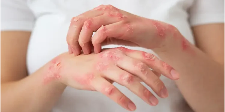 How to Identify Scabies: What Does Scabies Look Like?
